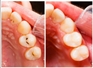Ученые создали пломбы, обновляющие поврежденные зубы