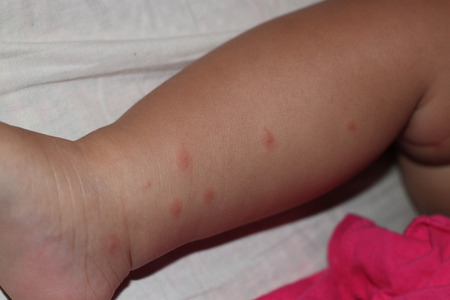 Отличия признаков укусов комарами и крапивницы